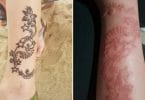 Dangerous 'black henna' tattoos leaving Bali tourists with permanent scars