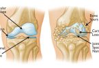 Chronic bone and joint diseases: Scientists explain