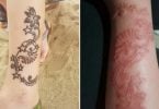 Dangerous 'black henna' tattoos leaving Bali tourists with permanent scars