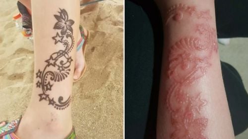 Li-tattoos tse kotsi tsa 'black henna' li siea bahahlauli ba Bali ba e-na le maqeba a sa feleng