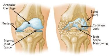 Chronic bone and joint diseases: Scientists explain