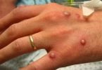 U primu casu di Monkeypox d'Israele signalatu dopu un viaghju in Europa