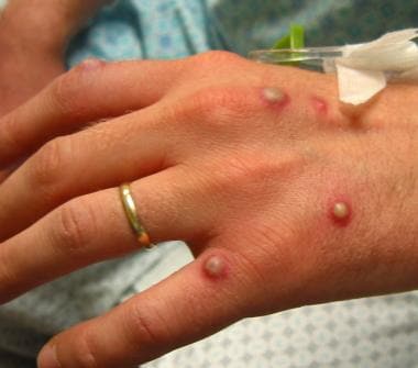 Israel's first monkeypox case reported after European trip