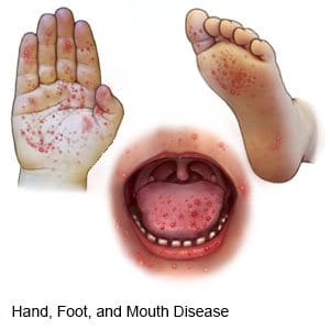 Foot and mouth