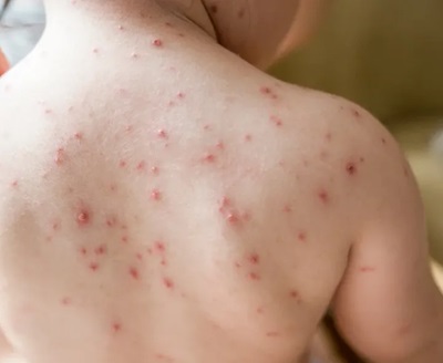measles - image courtesy of healthline